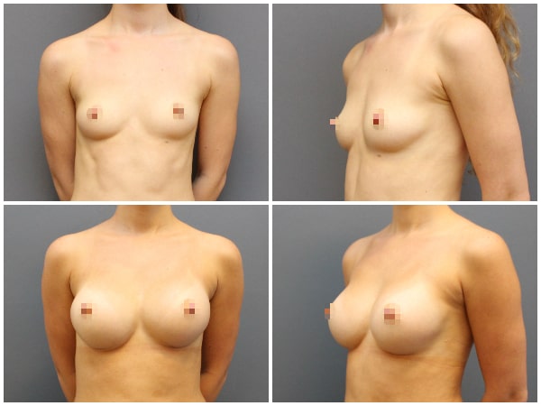 Breast augmentation before after