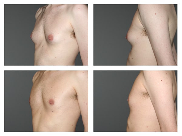 Male breast reduction before after