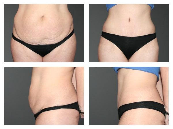 Abdominoplasty before & after