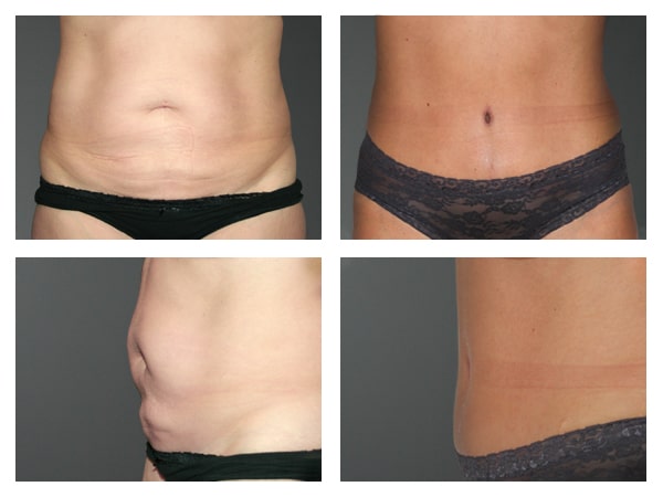 Tummy tuck before after