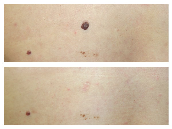 Mole removal with laser
