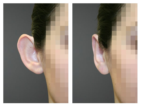 Otoplasty/ear pinning before and after