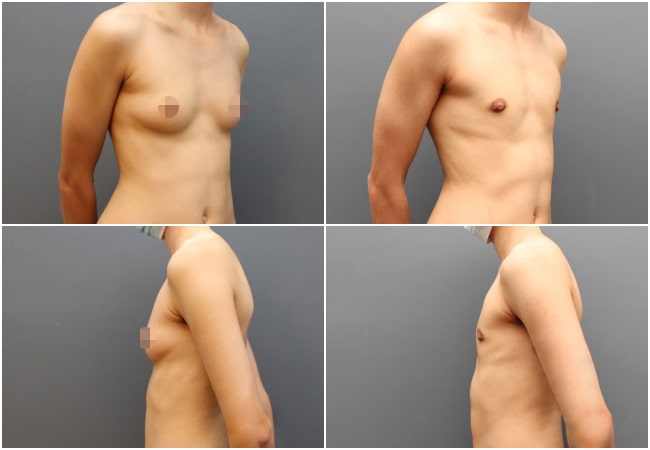 Female to Male Top Surgery