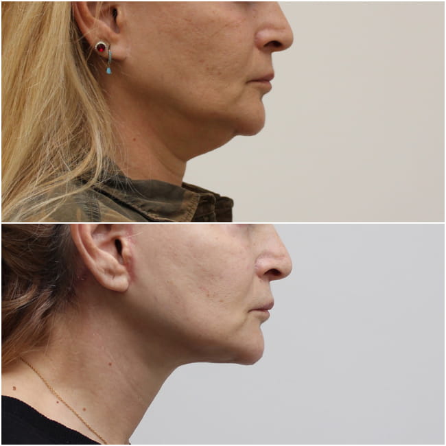 Λίφτινγκ λαιμού (neck lift). Πριν και έξι εβδομάδες μετά την επέμβαση.
