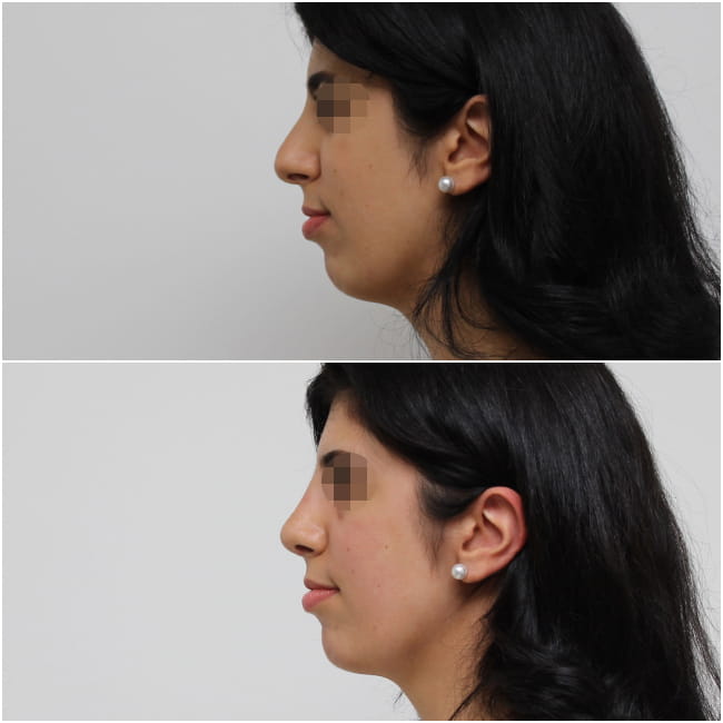 Rhinoplasty Thessaloniki before and after