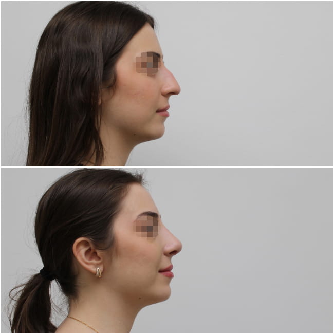 Rhinoplasty Thessaloniki Greece