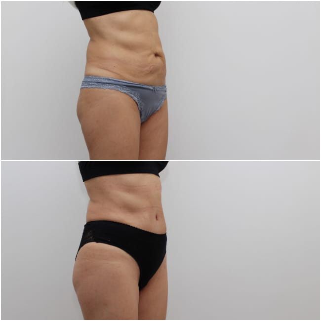 abdominoplasty (tummy tuck) before and after