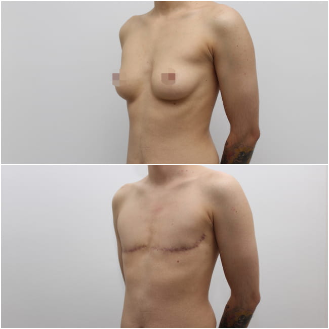 No nipples top surgery