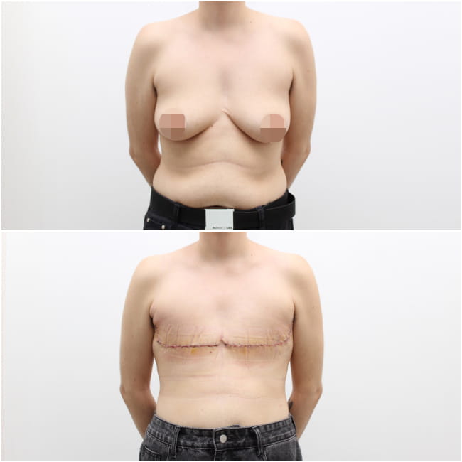 Top Surgery with No Nipple Grafts